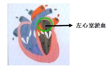 医疗卫生招聘考试护理知识：风湿性心脏病之瓣膜病难点解析2