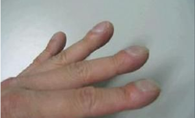 医疗考试重点：“杵状指”常见考点总结1