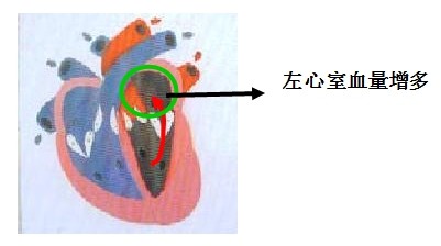 医疗卫生招聘考试护理知识：风湿性心脏病之瓣膜病难点解析3