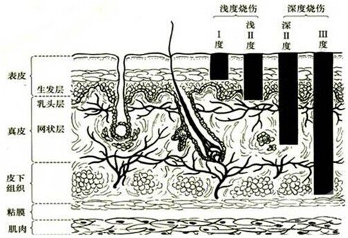 医疗卫生招聘考试临床外科：烧伤重要考点2
